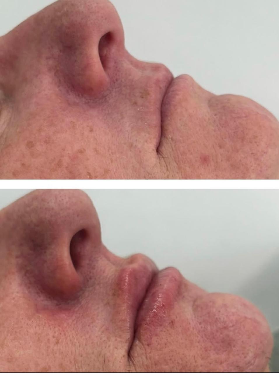 Ante e depois do preenchimento labial