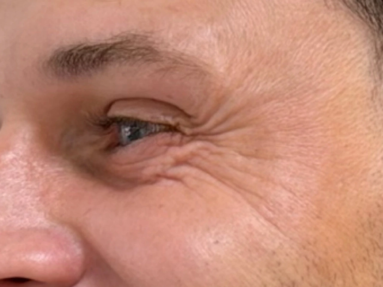 Antes, caso 01 de Botox