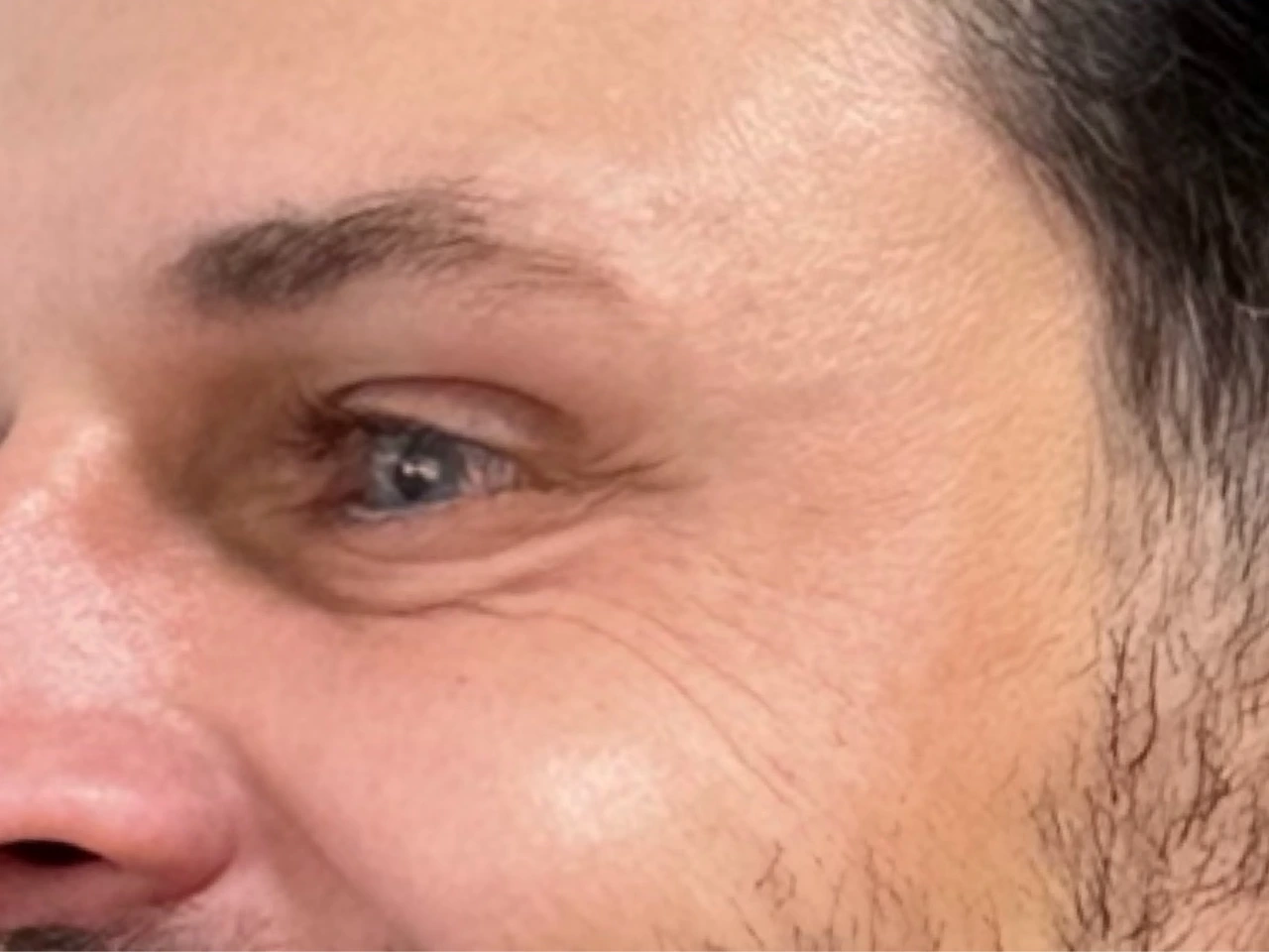 Depois, caso 01 de Botox