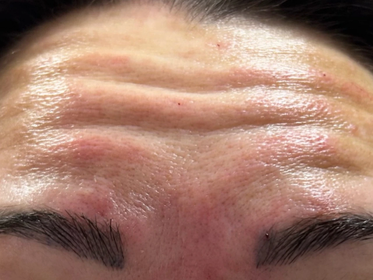 Antes, caso 02 de Botox