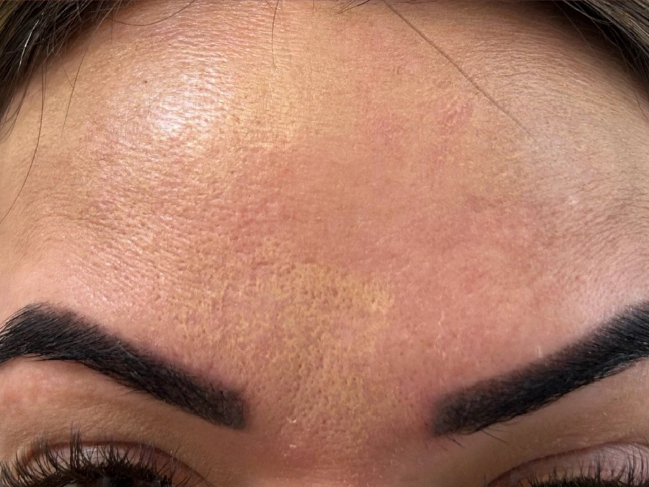 Depois, caso 02 de Botox