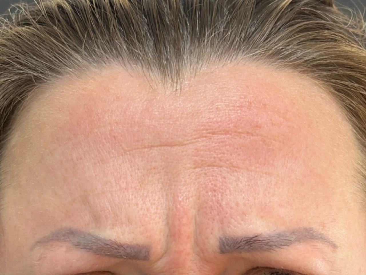 Antes, caso 03 de Botox