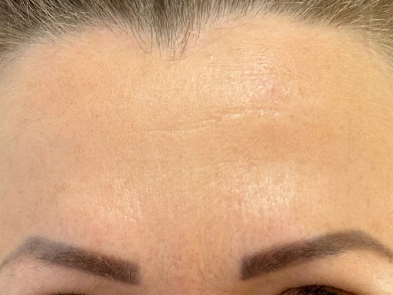 Depois, caso 03 de Botox