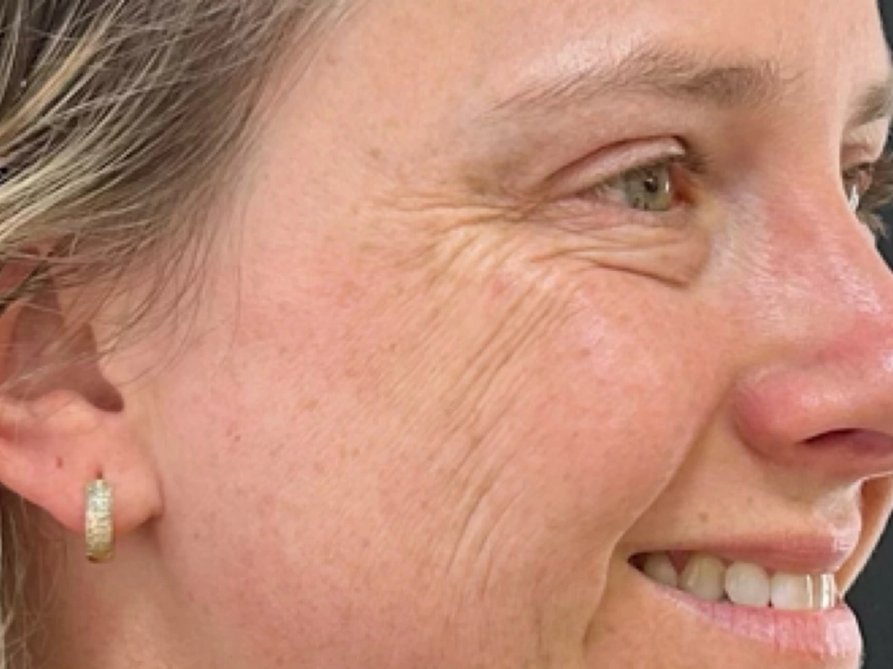 Antes, caso 04 de Botox