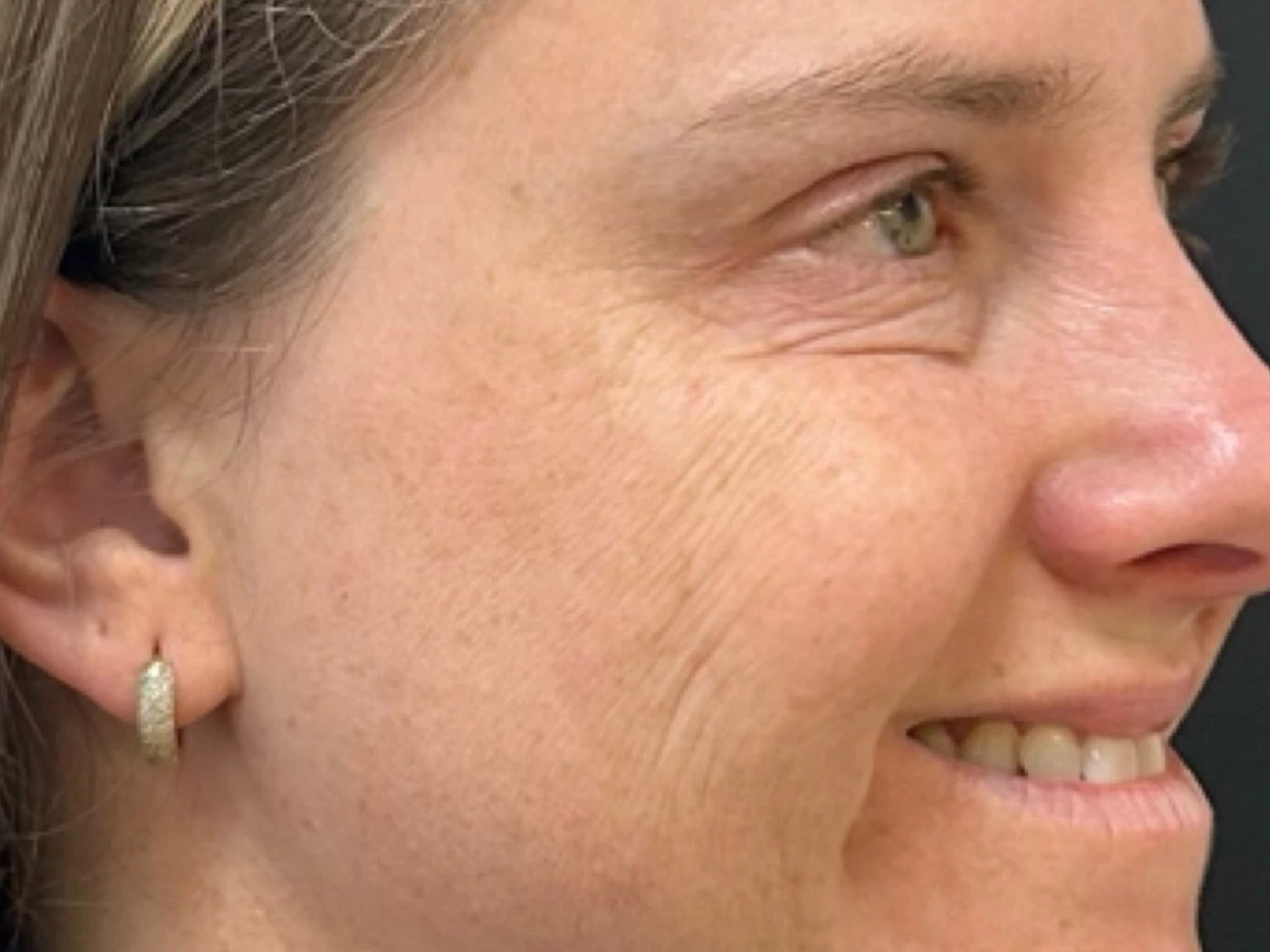 Depois, caso 04 de Botox