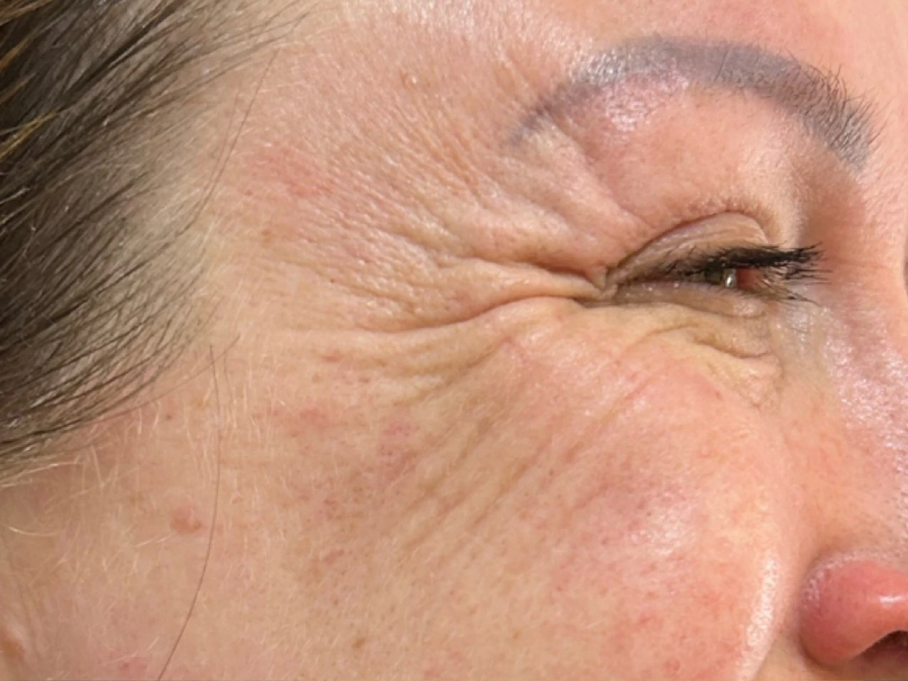 Antes, caso 05 de Botox