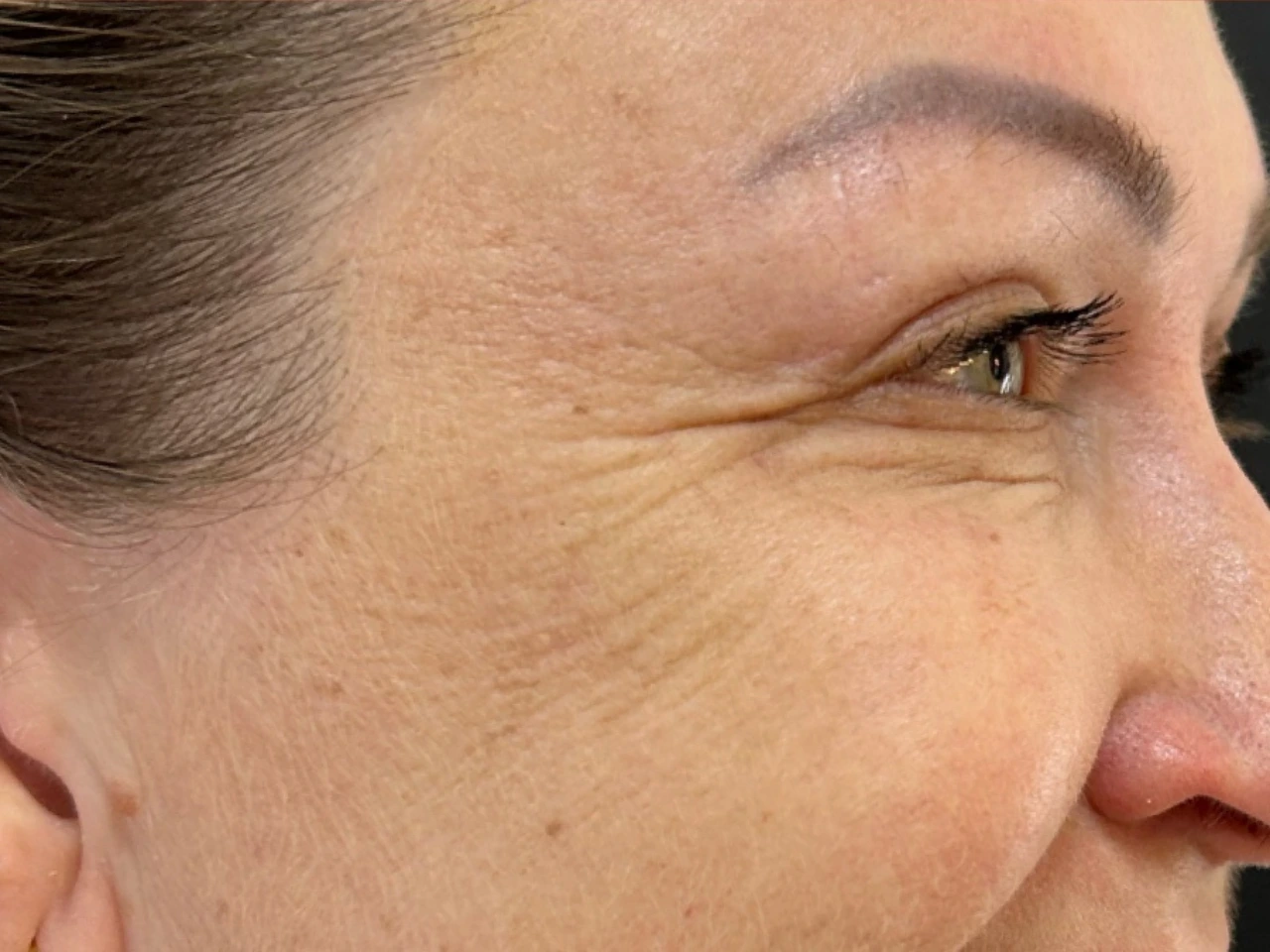 Depois, caso 05 de Botox