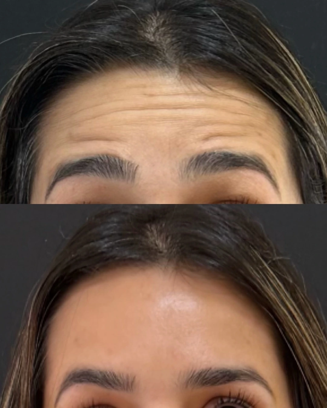 Antes e depois de Botox