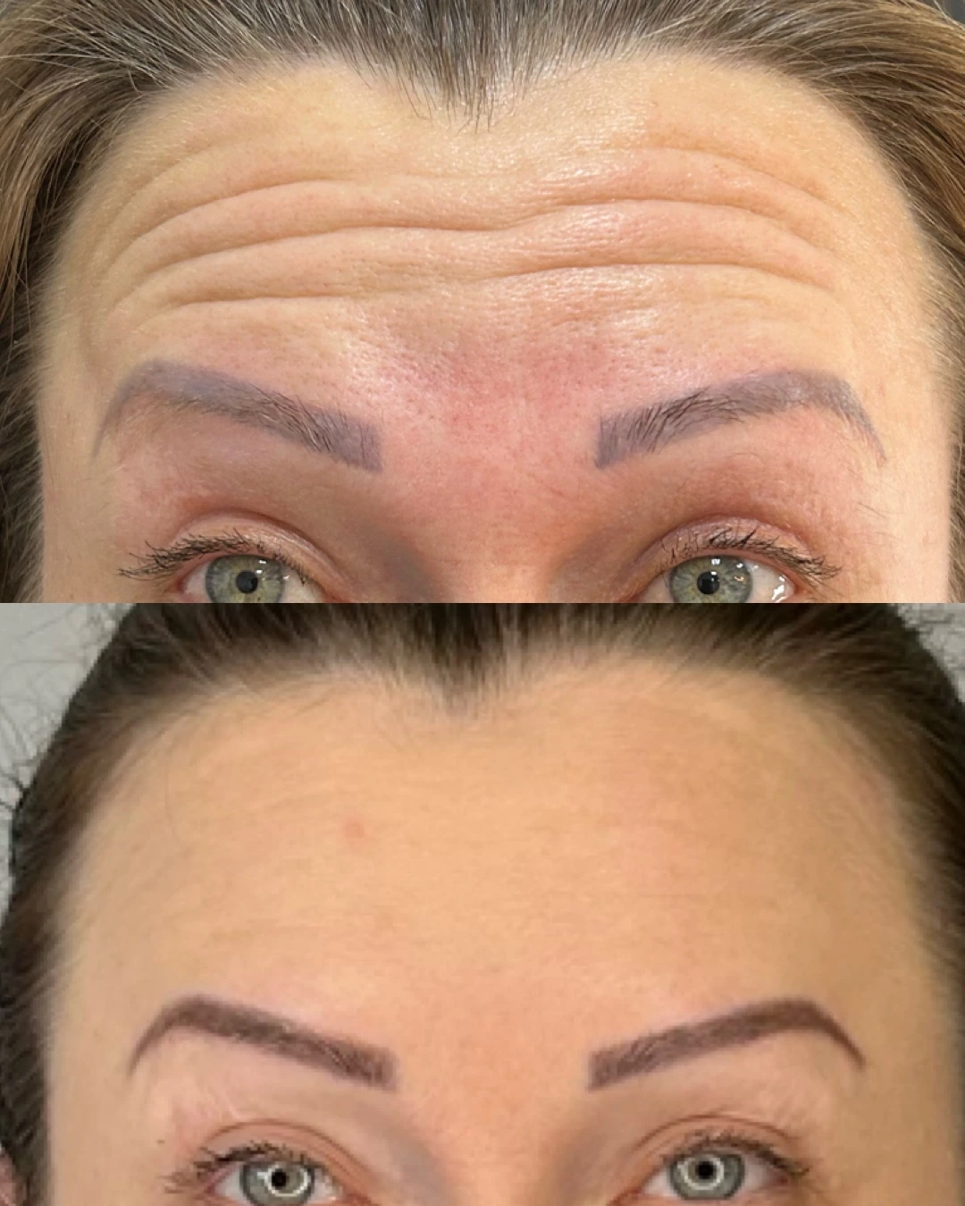 Antes e depois de Botox