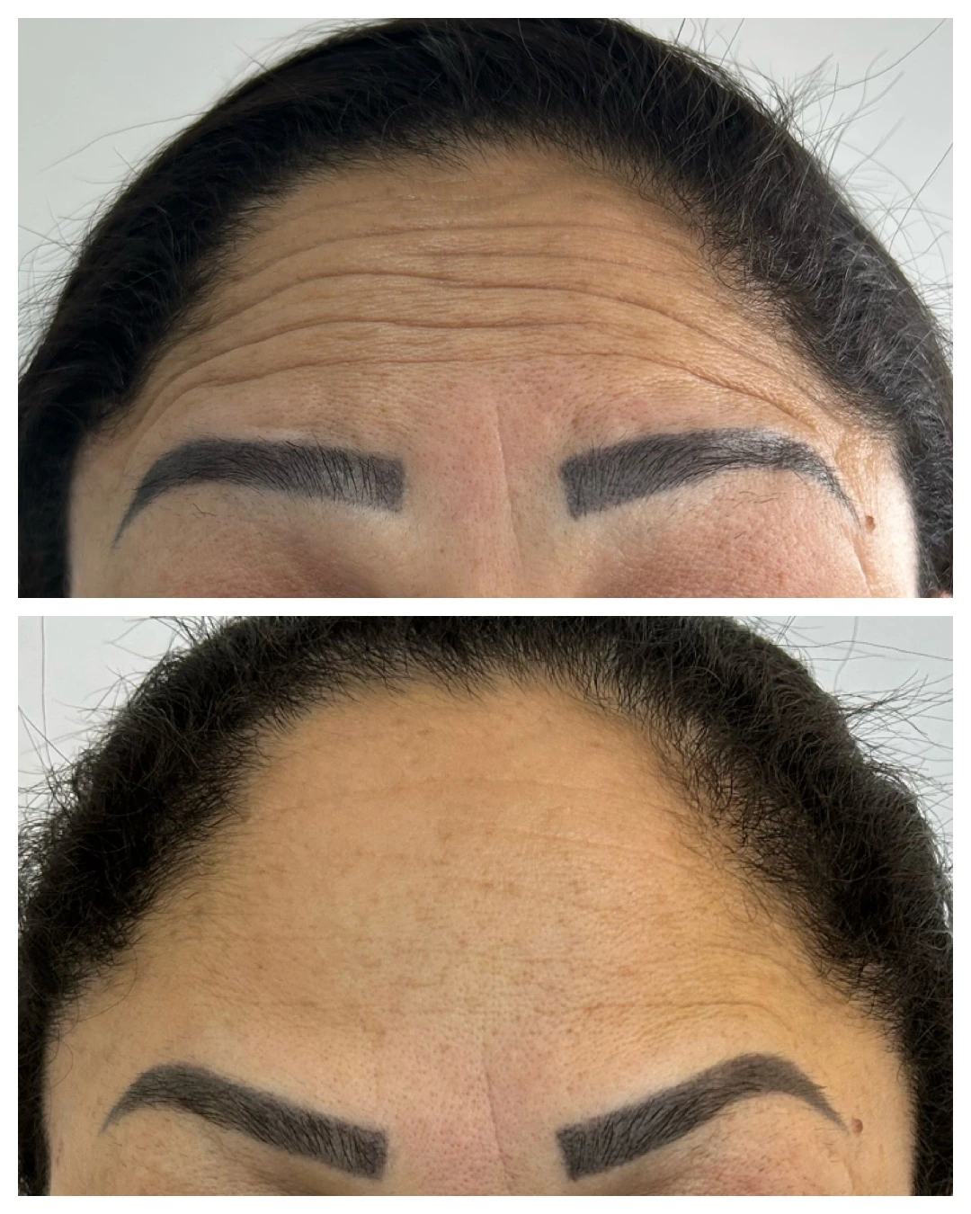 Antes e depois de Botox