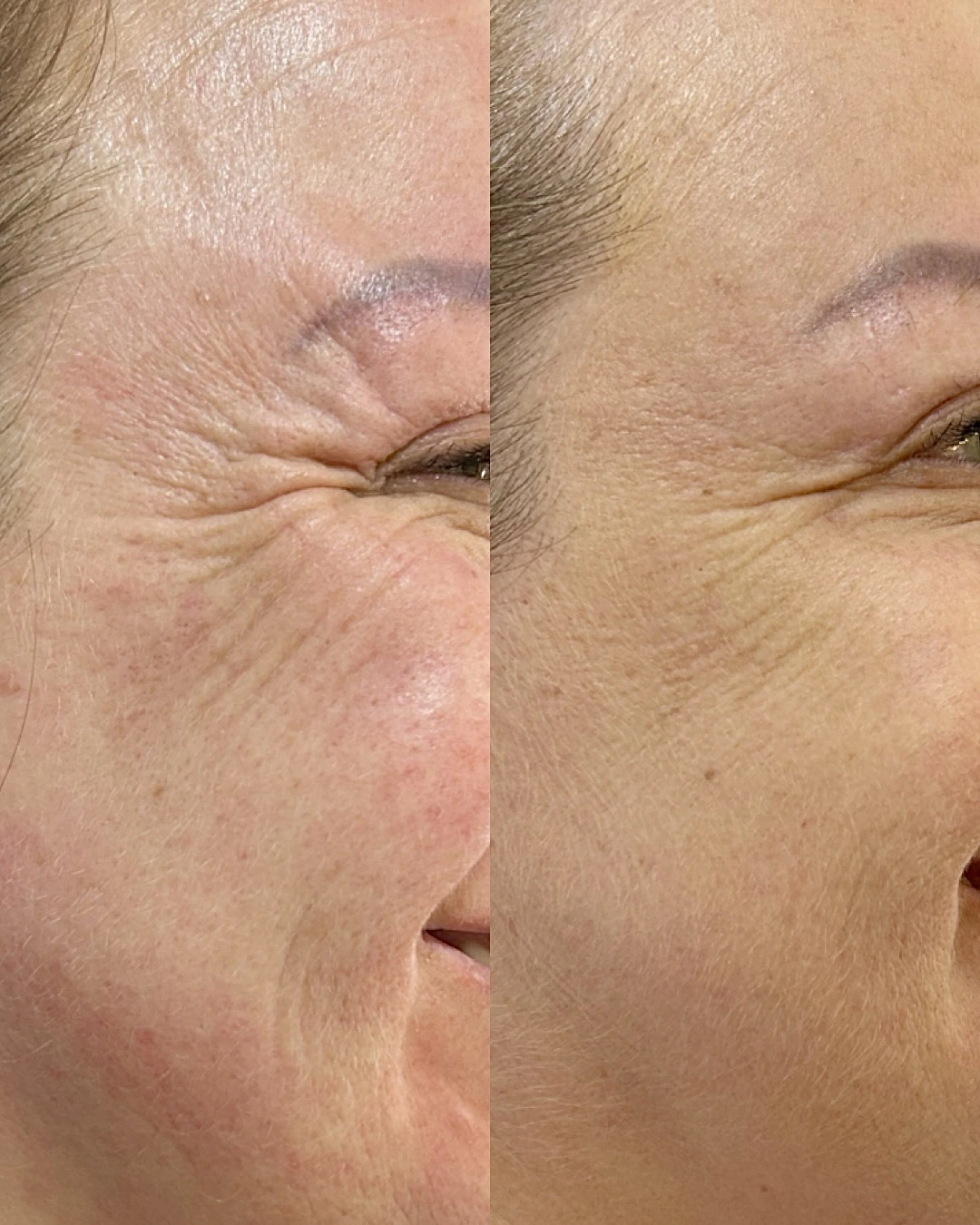 Antes e depois de Botox