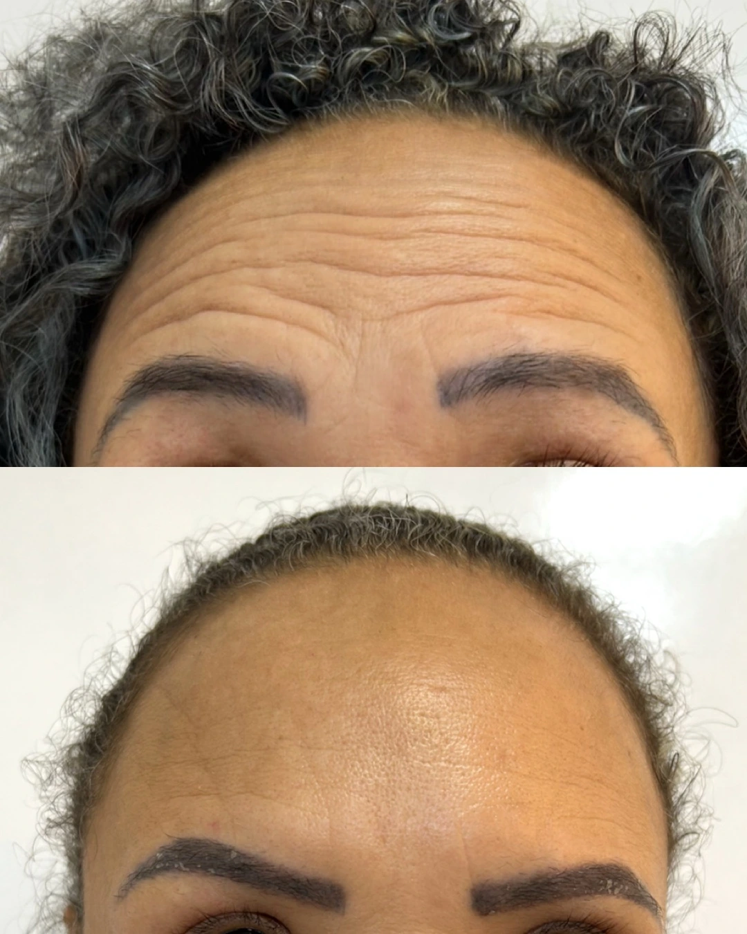Antes e depois de Botox