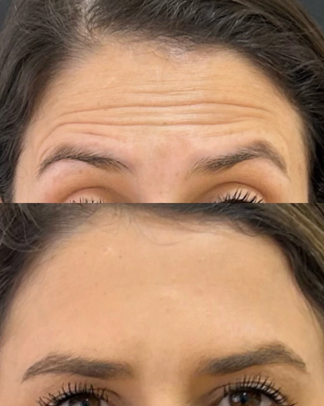 Antes e depois de Botox