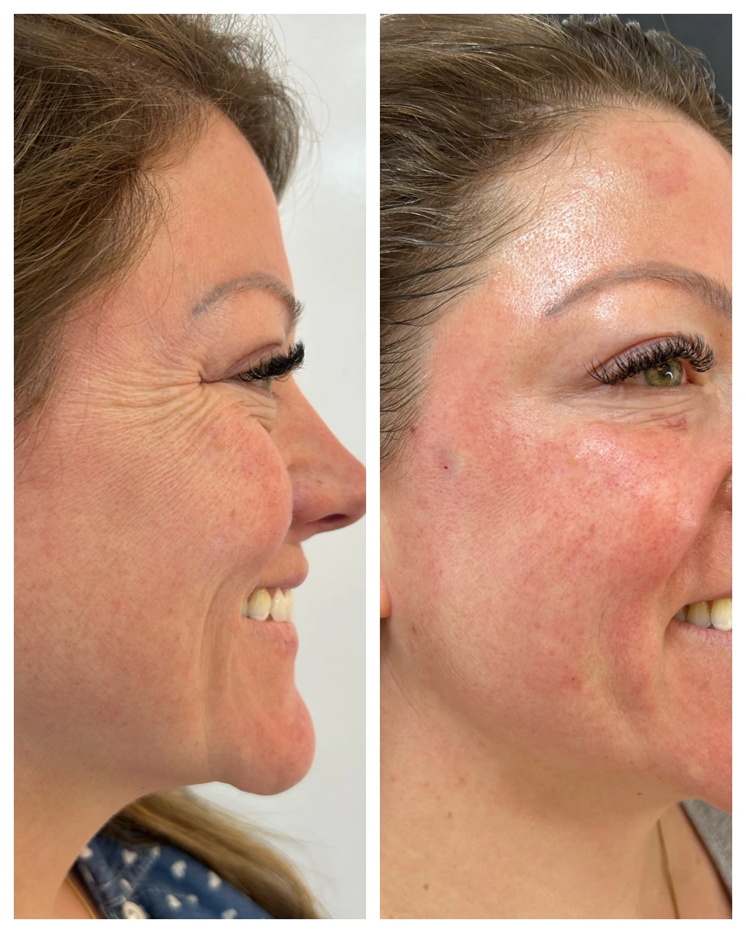 Antes e depois do Protocolo DermaLumi