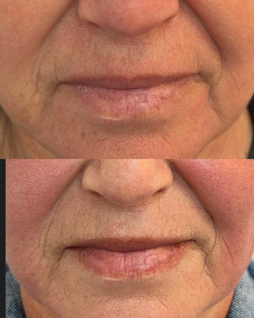 Antes e depois do Protocolo DermaLumi