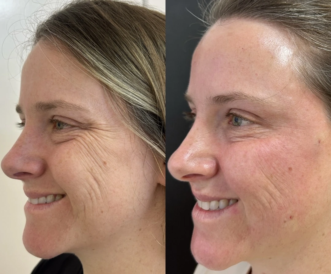 Antes e depois do Protocolo DermaLumi