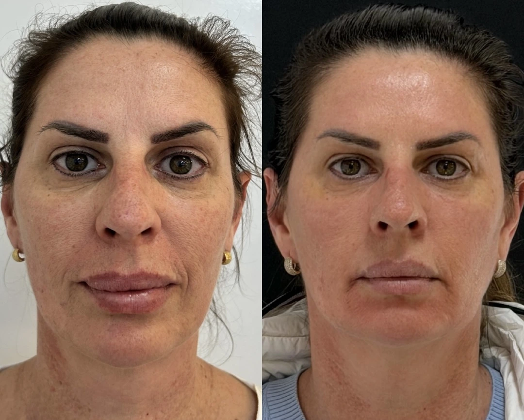 Antes e depois do Protocolo DermaLumi