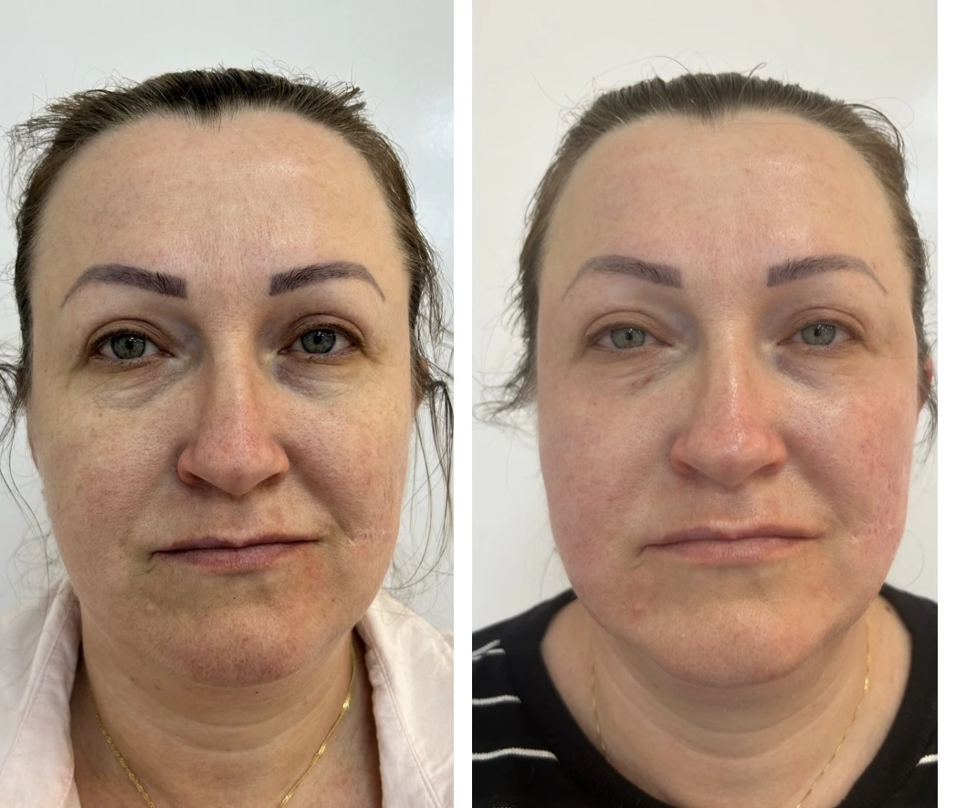 Antes e depois do Protocolo DermaLumi