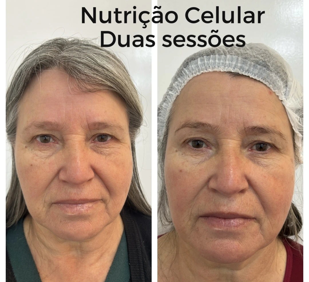 Antes e depois do Protocolo DermaLumi