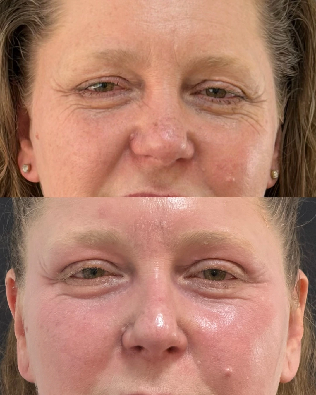 Antes e depois de New Skin